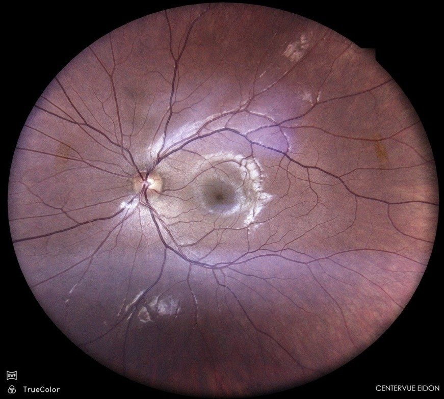 Fond d'œil montrant une atteinte de la macula (DMLA)