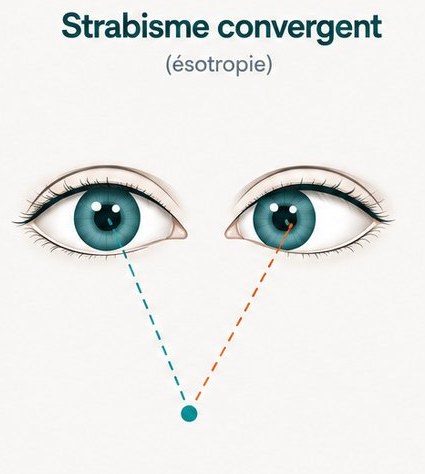 Schéma d'un strabisme convergent : un œil dévie vers l'intérieur